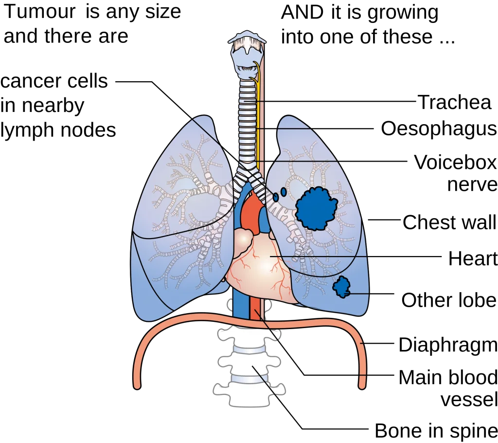 What are some of the tests done in lung cancer?