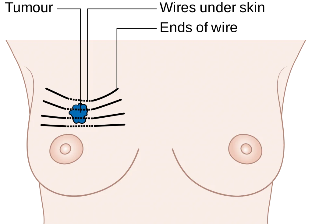 Epidemiology of breast cancer