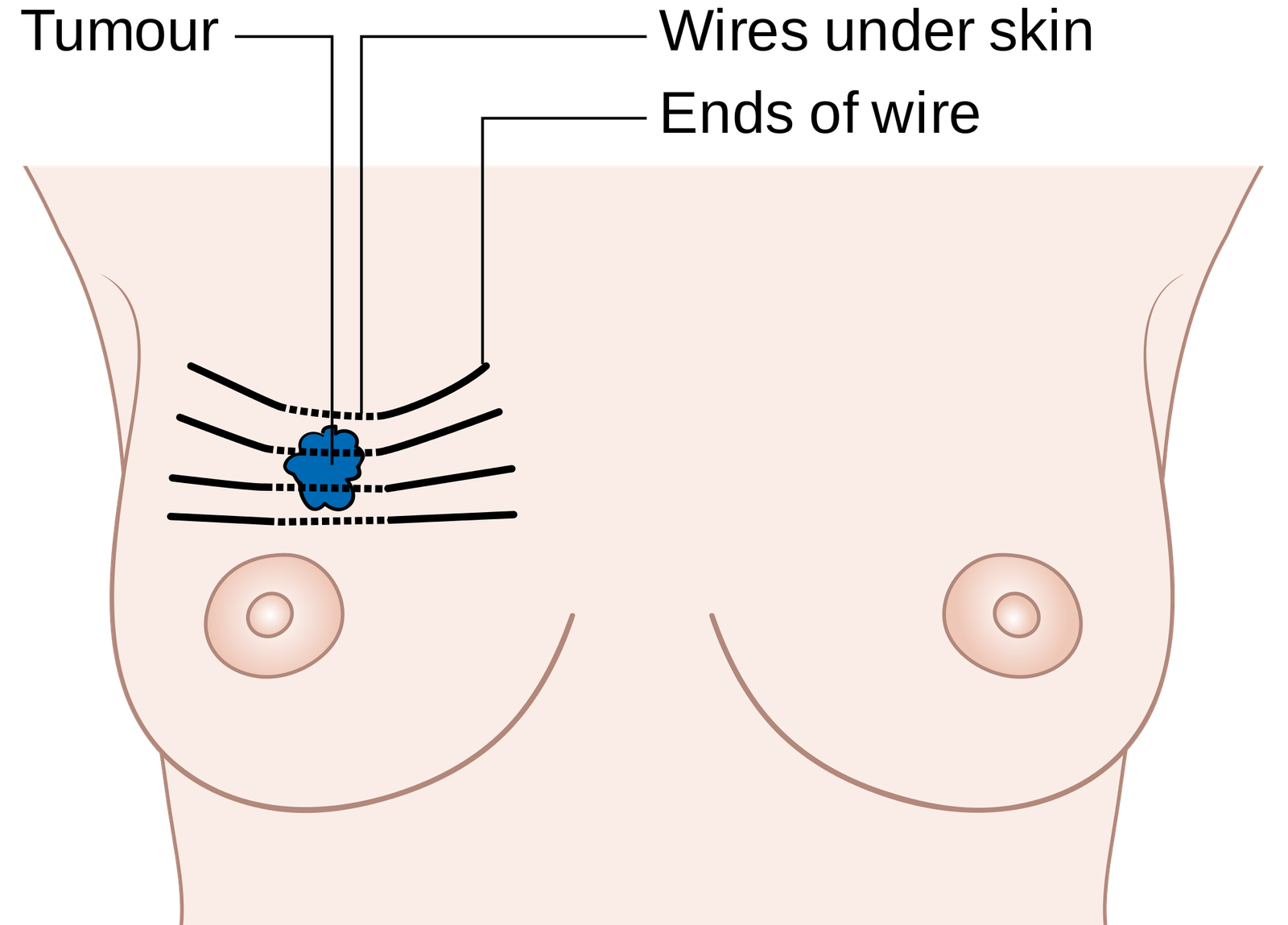 Epidemiology of breast cancer