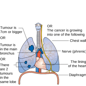 How do those with lung cancer present