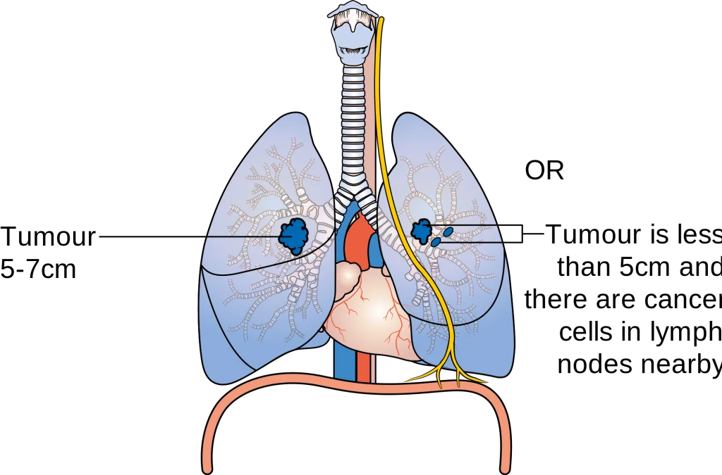 Lung cancer