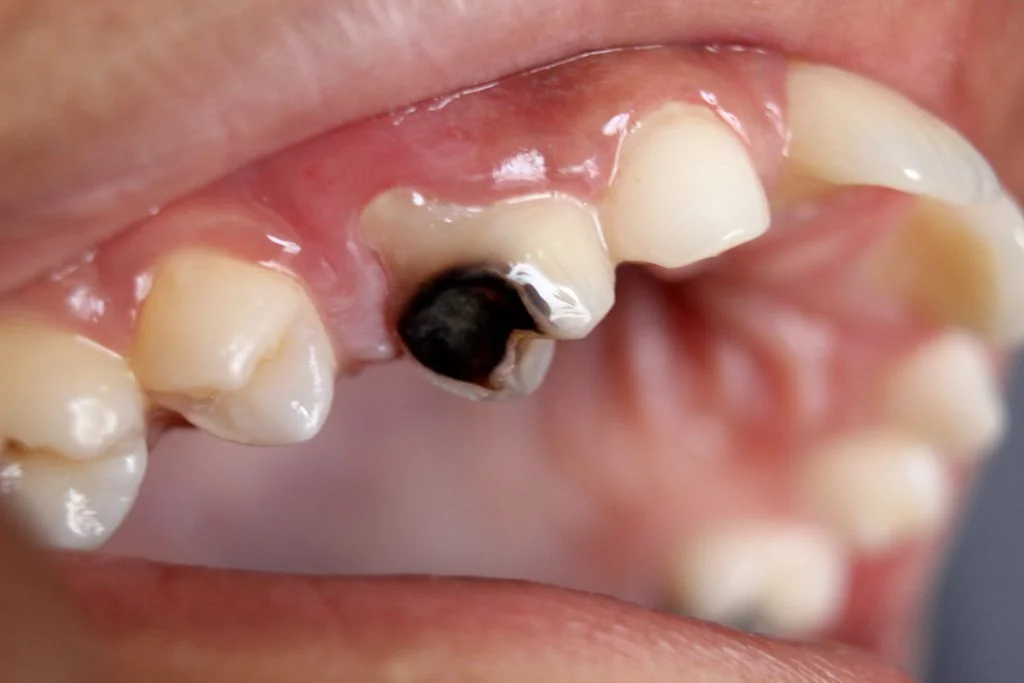 Dental Caries